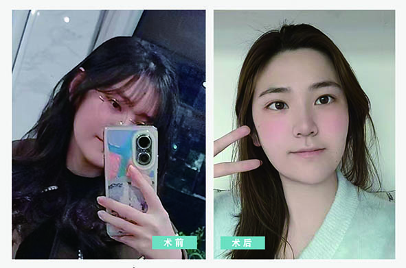 营口何氏眼科医院员工摘镜日记    第六期